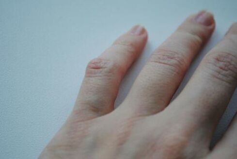 An arthritic lump appeared on the little finger. 