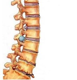How does osteochondrosis of the cervical region develop