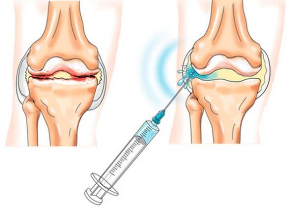 intra-articular injections for osteoarthritis of the knee
