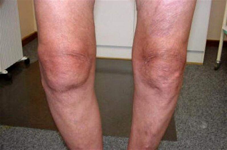 swelling of the knee due to arthritis