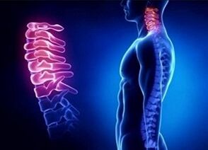 The causes of the development of cervical osteochondrosis