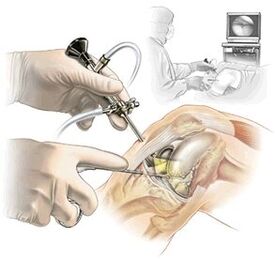 Clarifying the diagnosis of dash arthrosis