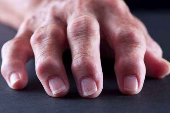 Joint deformities of the fingers due to arthrosis or arthritis